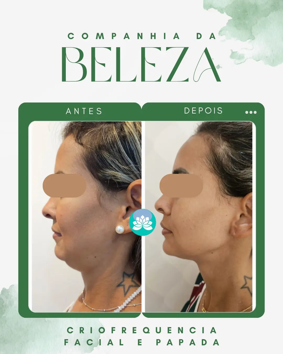 Criofrequencia Facial e papada
