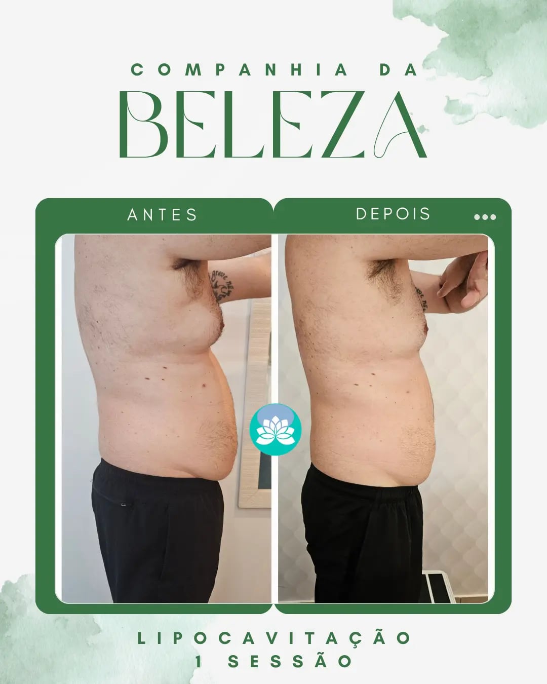 Lipocavitação 1ª sessão