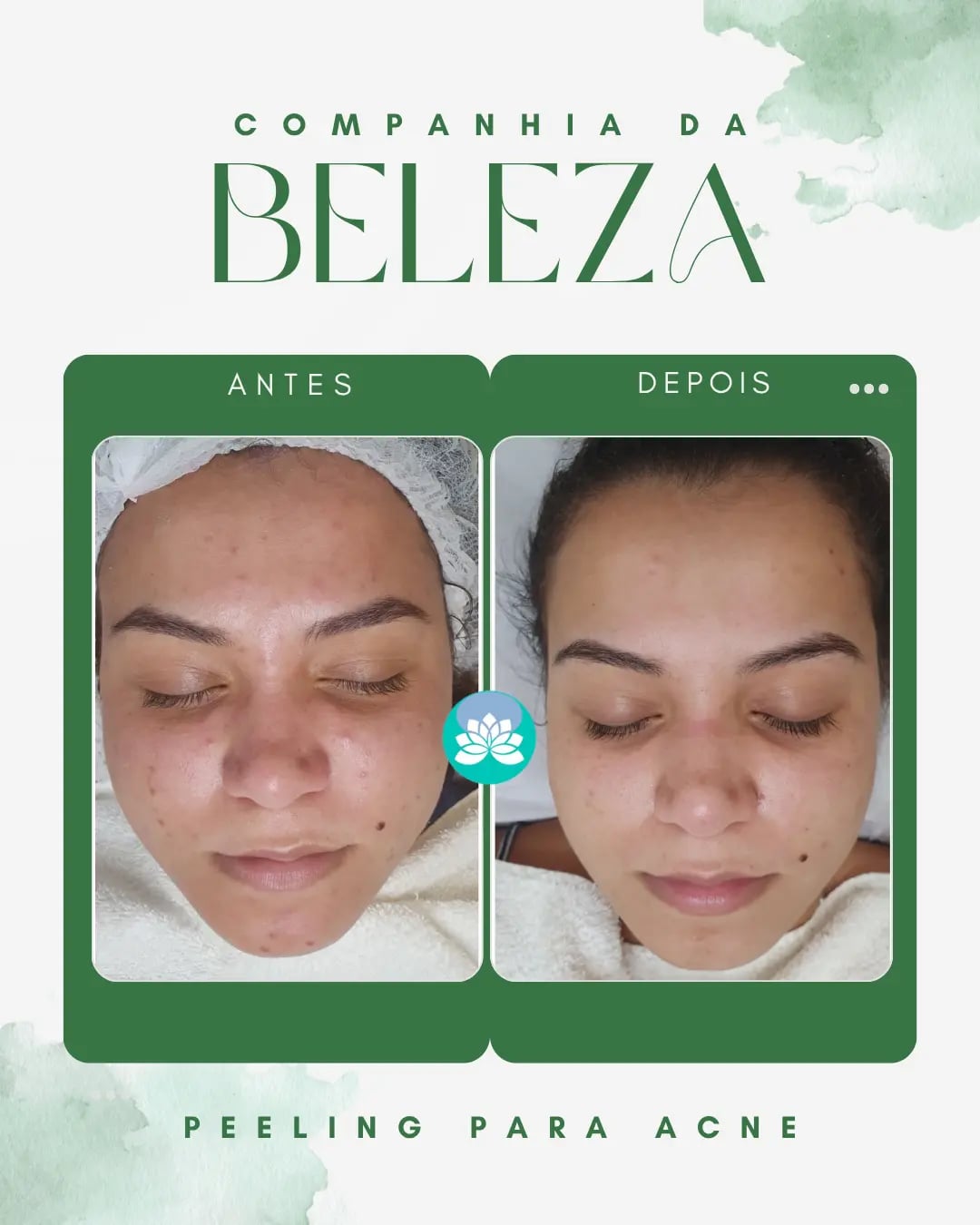 Peeling para acne