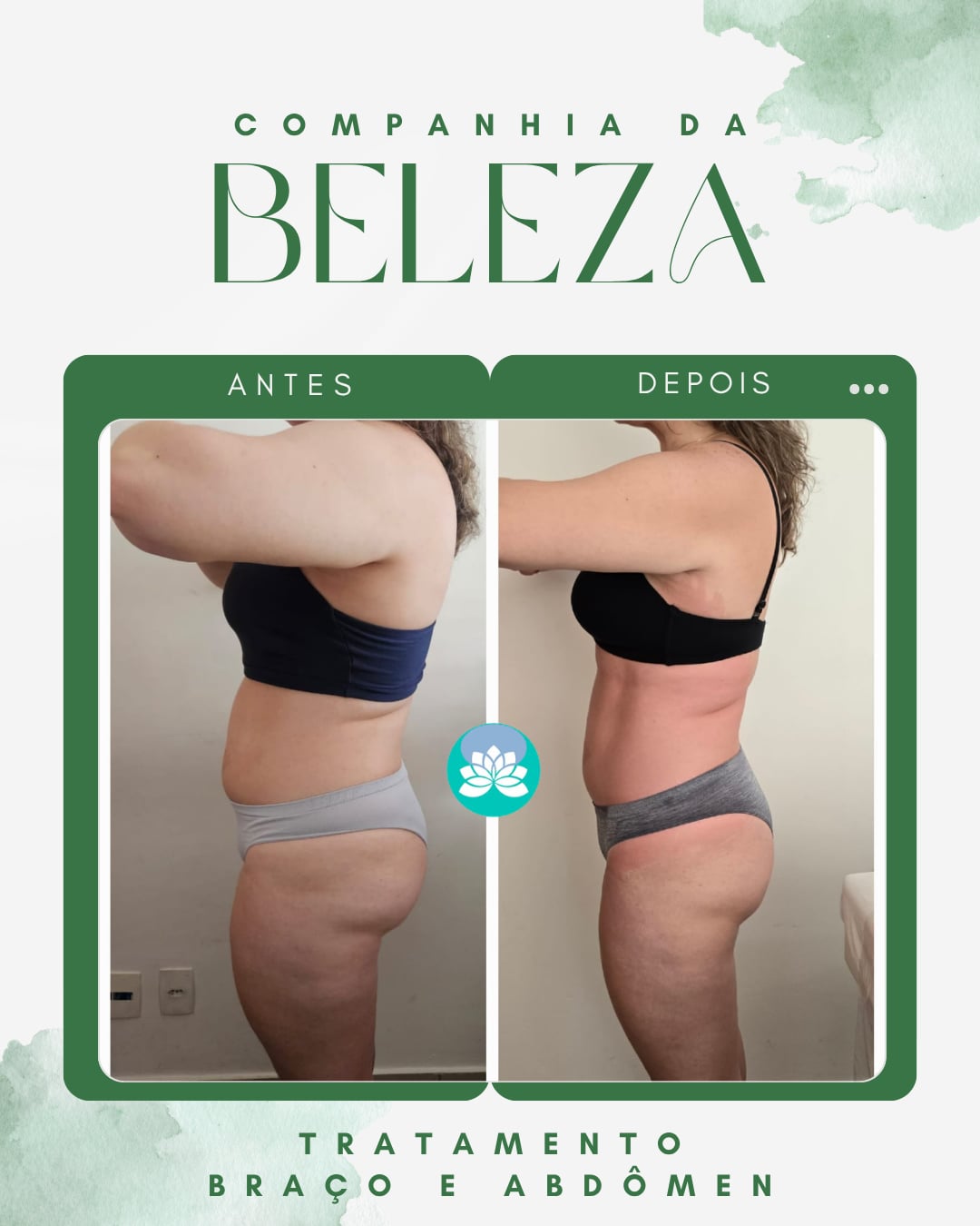 Tratamento Braco e abdomen